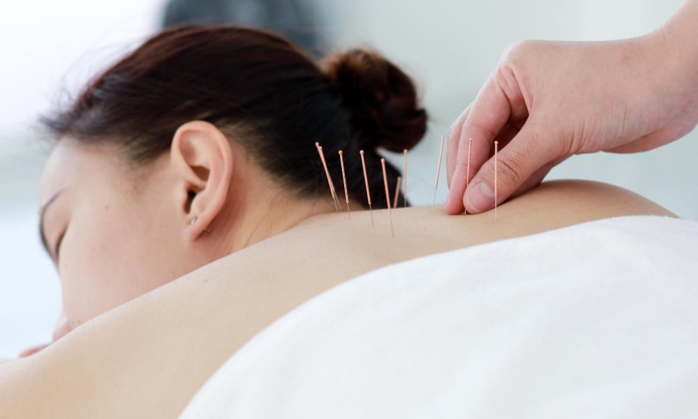 Acupuncture
